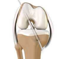 ACL Reconstruction