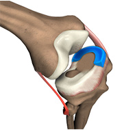 Meniscal Surgery