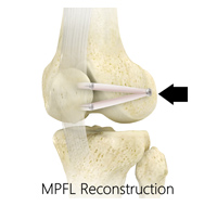 MPFL Reconstruction