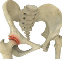 Osteoarthritis of the Hip 