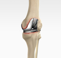 Revision Knee Replacement