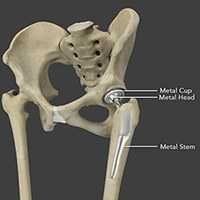 Total Hip Replacement